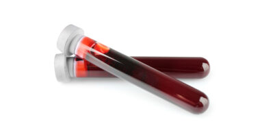 NfL as blood biomarker