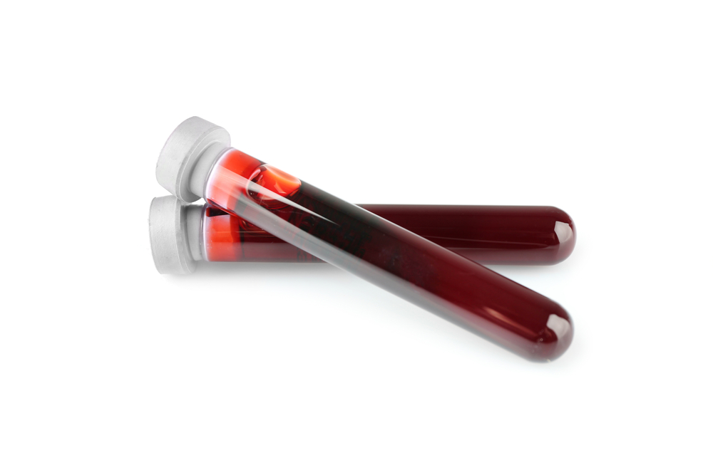 NfL as blood biomarker