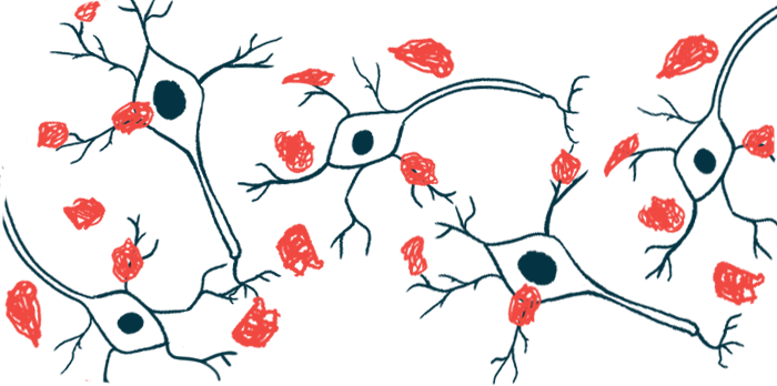 Amyloid plaques are shown forming on nerve cells.