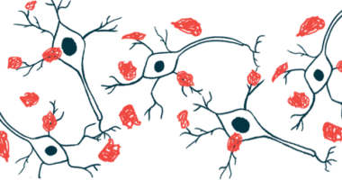 An illustration shows a close-up view of amyloid plaques, or protein clumps.