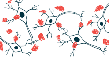 An illustration shows amyloid plaques.