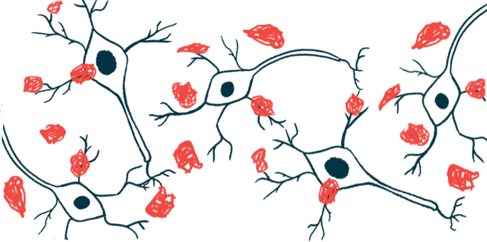 An illustration shows amyloid plaques.